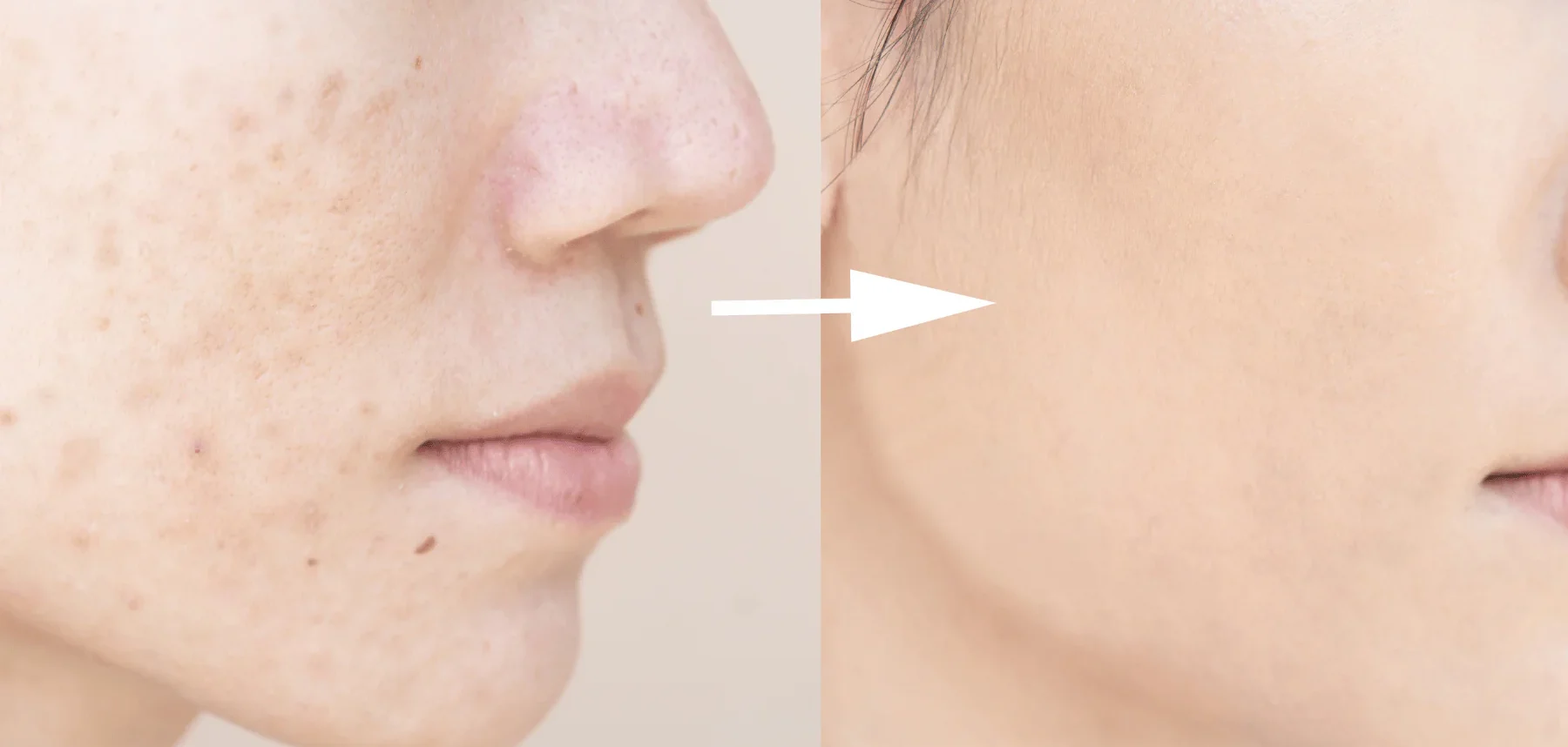 Beef Tallow Skin Care Before and After Transformations